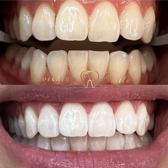 Teeth Whitening Pen. 16% Hydrogen Peroxide. No LED Accelerator Light needed. - Picture 7 of 7